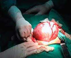 Myoma extraction